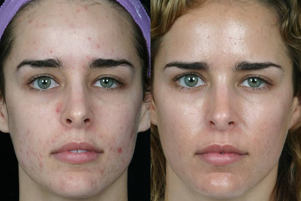 Какая чистка лица самая эффективная? виды чистки лица у косметолога | afrodita-spa.ru