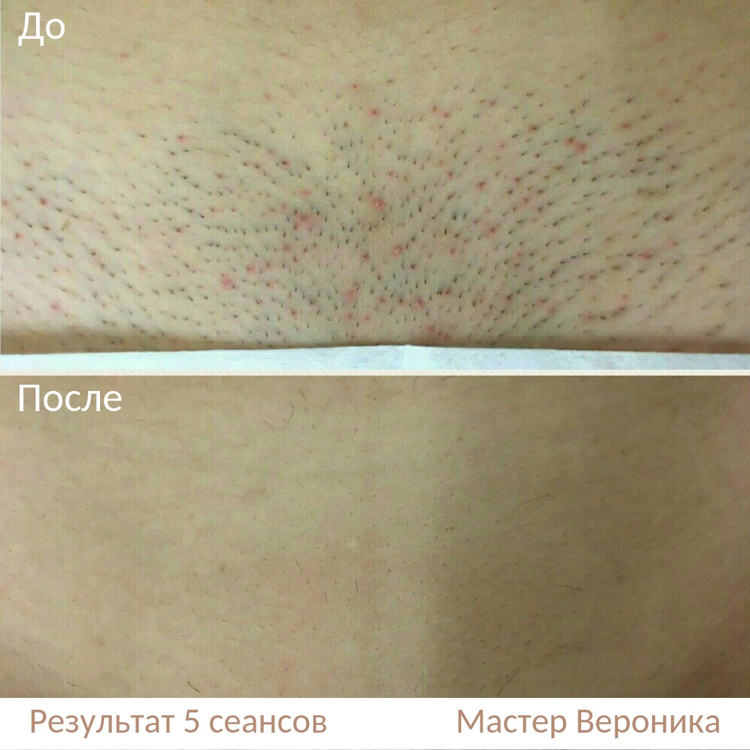 Лазерная эпиляция: кому подходит, основные противопоказания, как подготовиться | world fashion channel