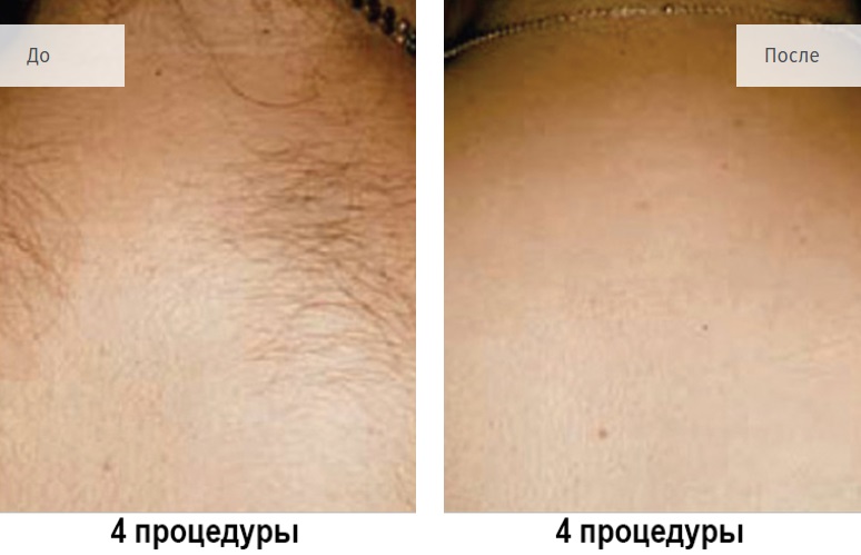 Фотоэпиляция в домашних условиях, ваксинг и другие методы самостоятельного удаления волос