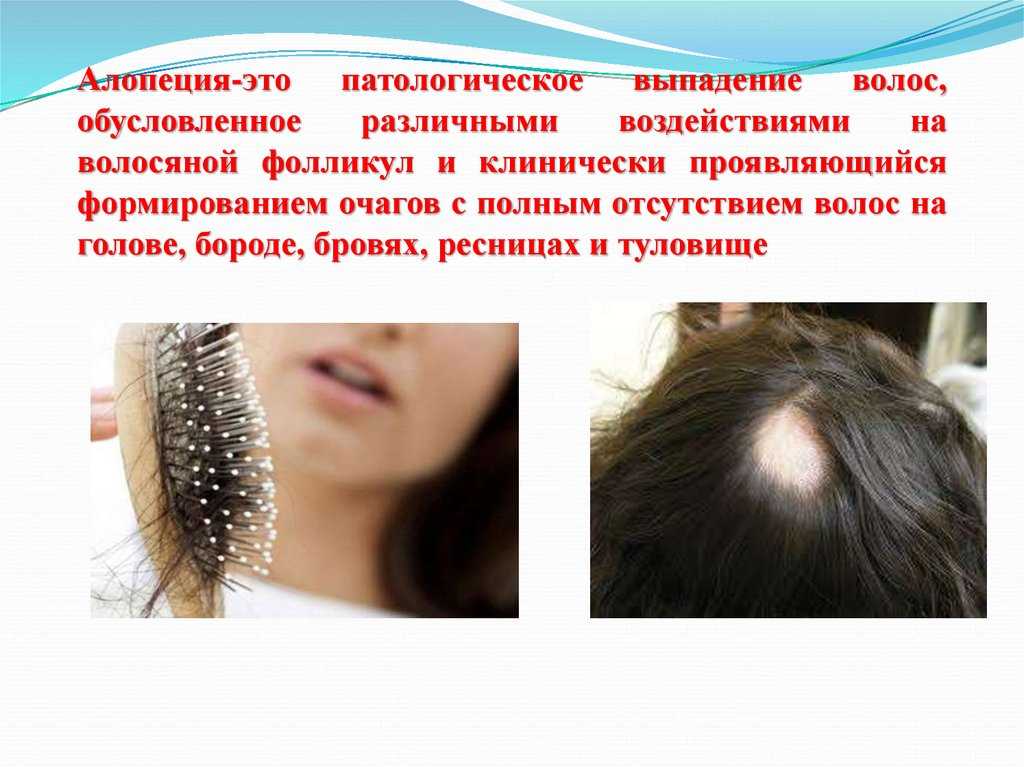 Выпадение волос: когда норма, а когда патология?