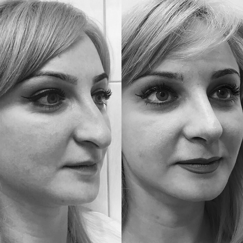 Лучшие врачи и клиники по ринопластике в турции