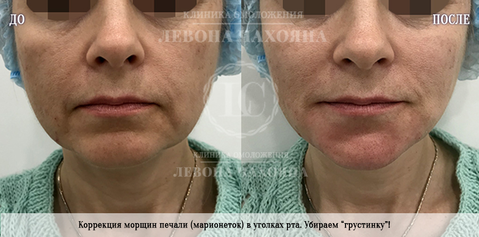 "синдром стервозного лица" - как от него избавиться? советы мастера по массажу лица и тренера по фейсбилдингу - новости кирова и кировской области