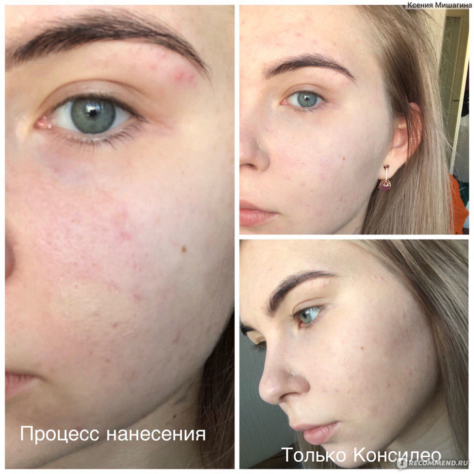 Как правильно замазать прыщи на лице?