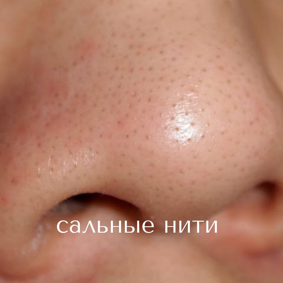 Черные точки на коже: почему они появляются и как от них избавиться?