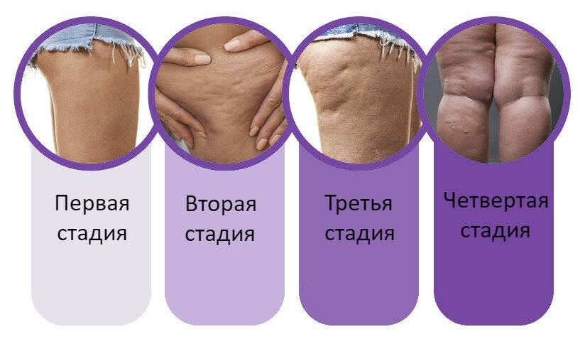 Типы фигуры у женщин: как определить, «яблоко», «груша» или «стручок»?
