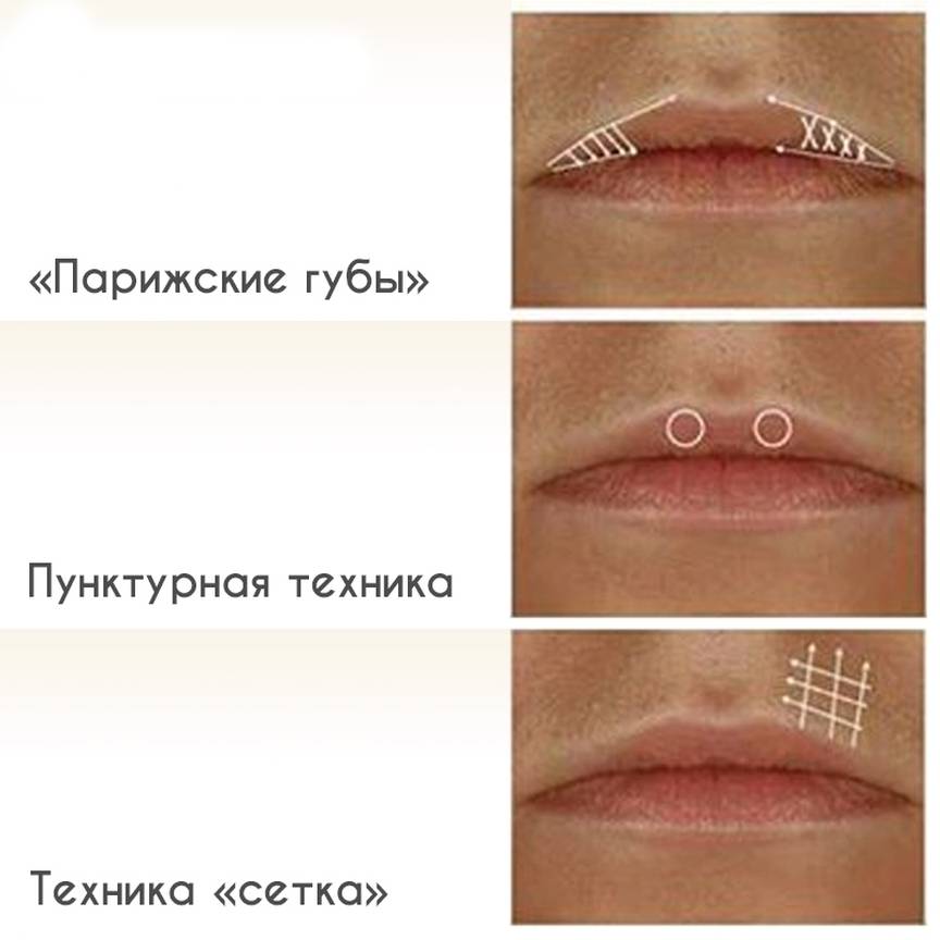 Какие способы увеличения губ существуют