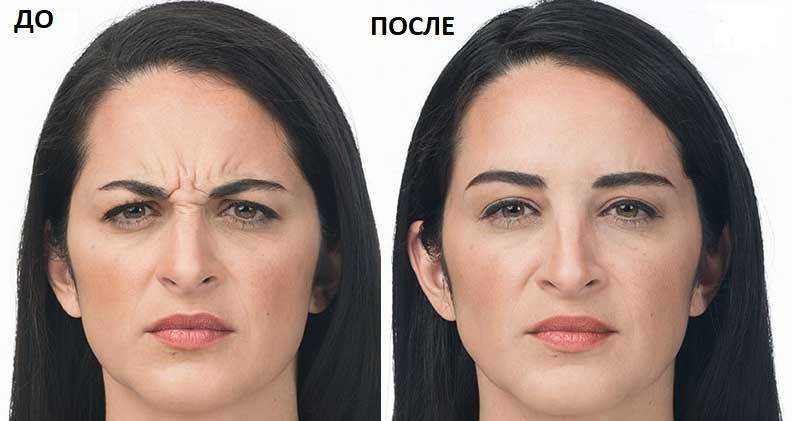 Что делать с морщинами на лбу?