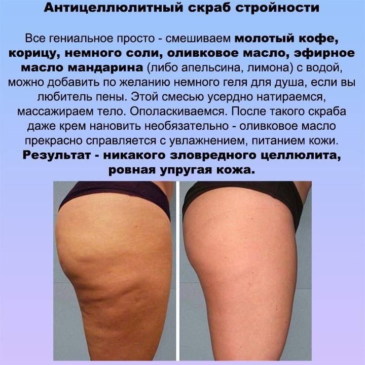 Четыре шага против целлюлита: щетка, банка, скраб, крем