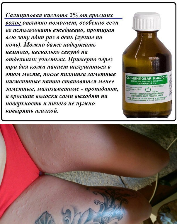 Что делать, если после депиляции или эпиляции врастают волосы?