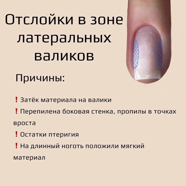 Почему гель-лак не держится на ногтях: ошибки маникюра, физиологические причины