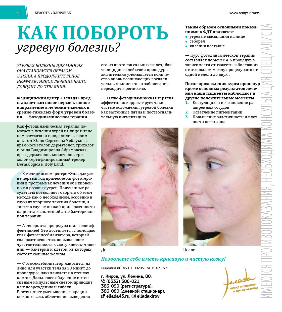 Как избавиться от прыщей в домашних условиях — 15 лучших средств