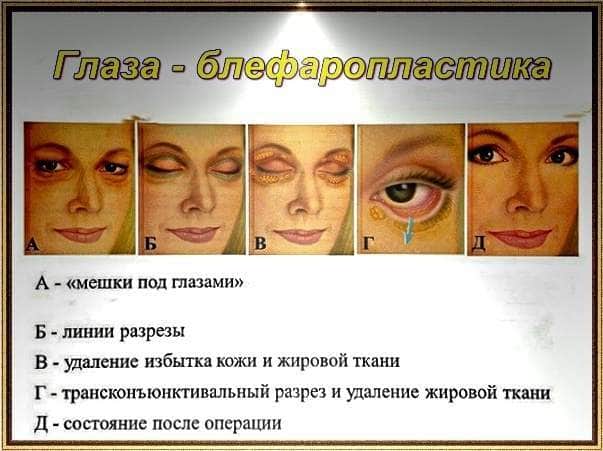 Отеки и мешки под глазами. причины появления. как избавиться?