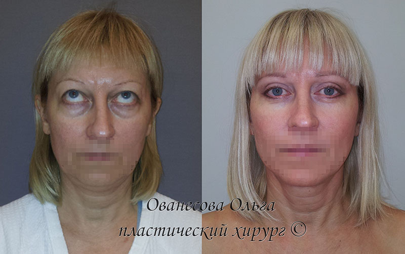 Чем опасна блефаропластика? осложнения и последствия