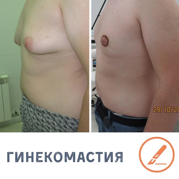 Гинекомастия у мужчин - что нужно знать