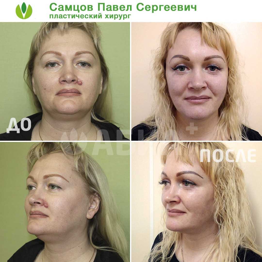 Как в домашних условиях убрать второй подбородок