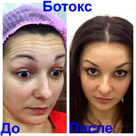 Что нельзя и что можно после «ботокса»: противопоказания и рекомендации после инъекций ботулотоксина