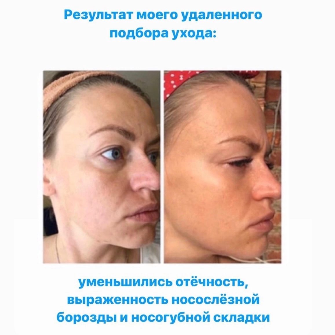 Как убрать мешки под глазами быстро и навсегда – советы специалиста