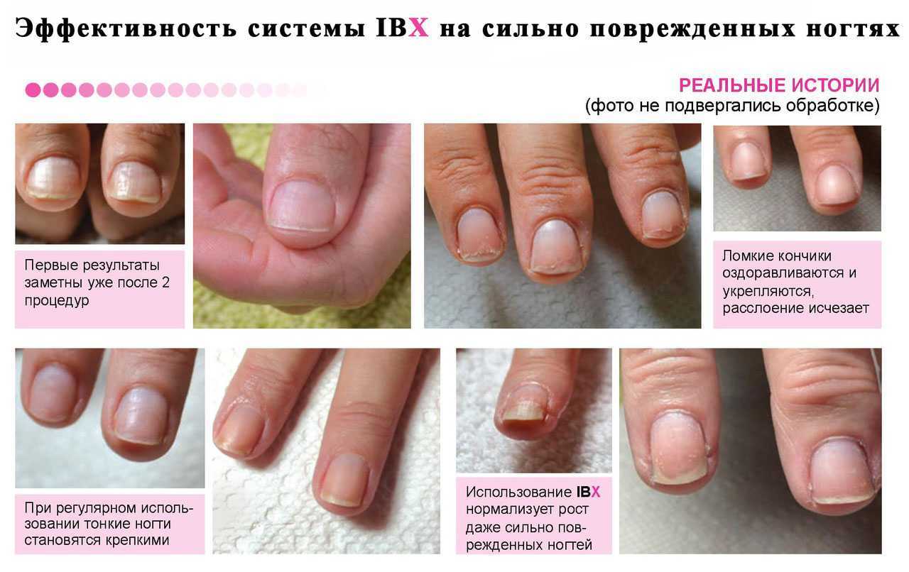 Как восстановить ногти после гель-лака