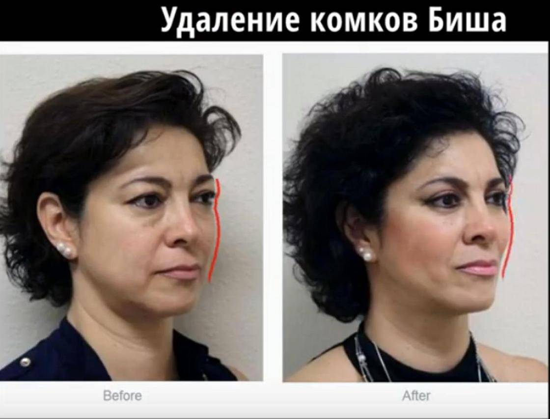 Удаление комков биша