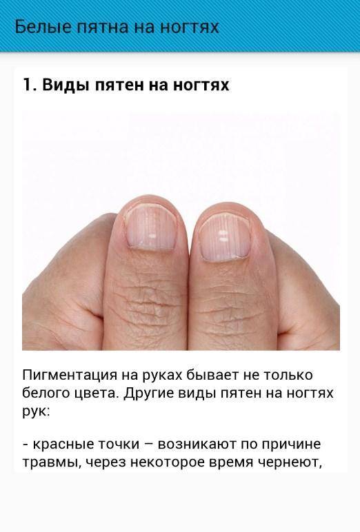 Что означают белые пятна на ногтях рук с точки зрения медиков