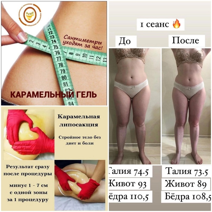 Карамельная липосакция - показания и противопоказания 💗 professionals beauty