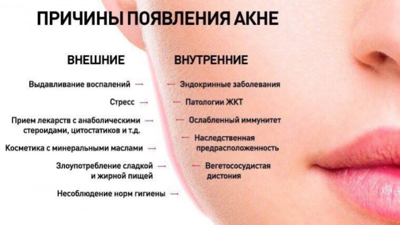 Эффективные методы борьбы с прыщами на лице и возвращение уверенности в себе
