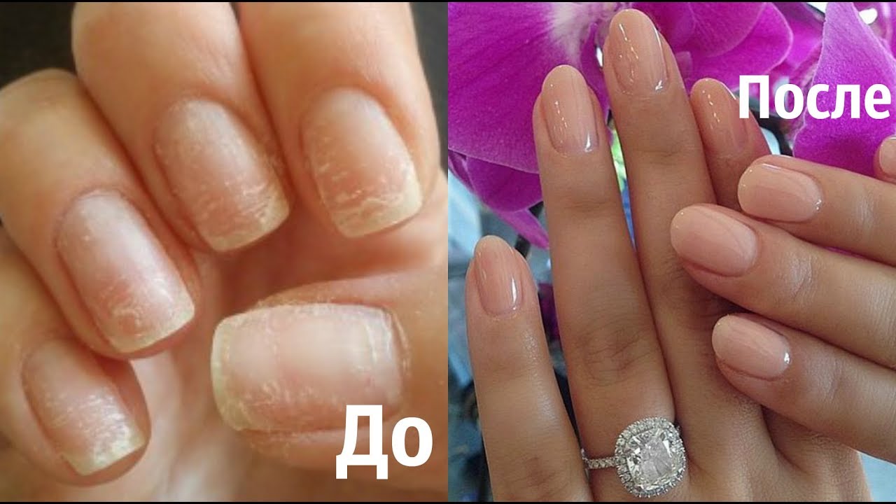 Аллергия на гель лак чем заменить — аллергия
