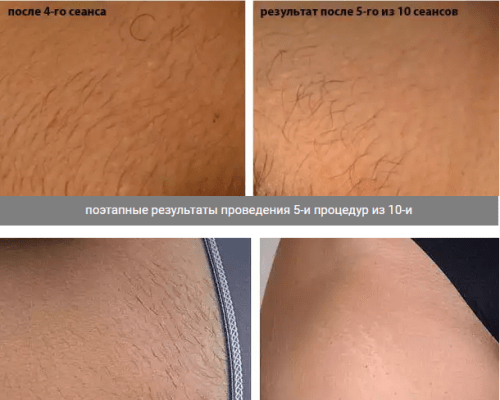 Какие бывают виды шугаринга зоны бикини: как выбрать вариант сахарной эпиляции интимной зоны