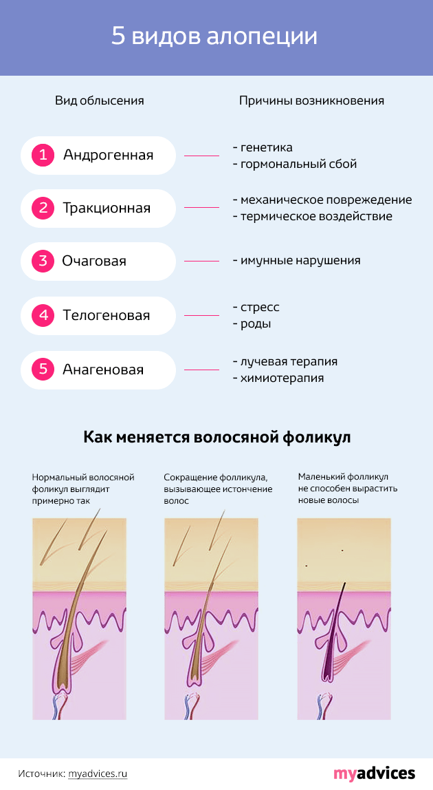 Выпадение волос у женщин: причины и лечение