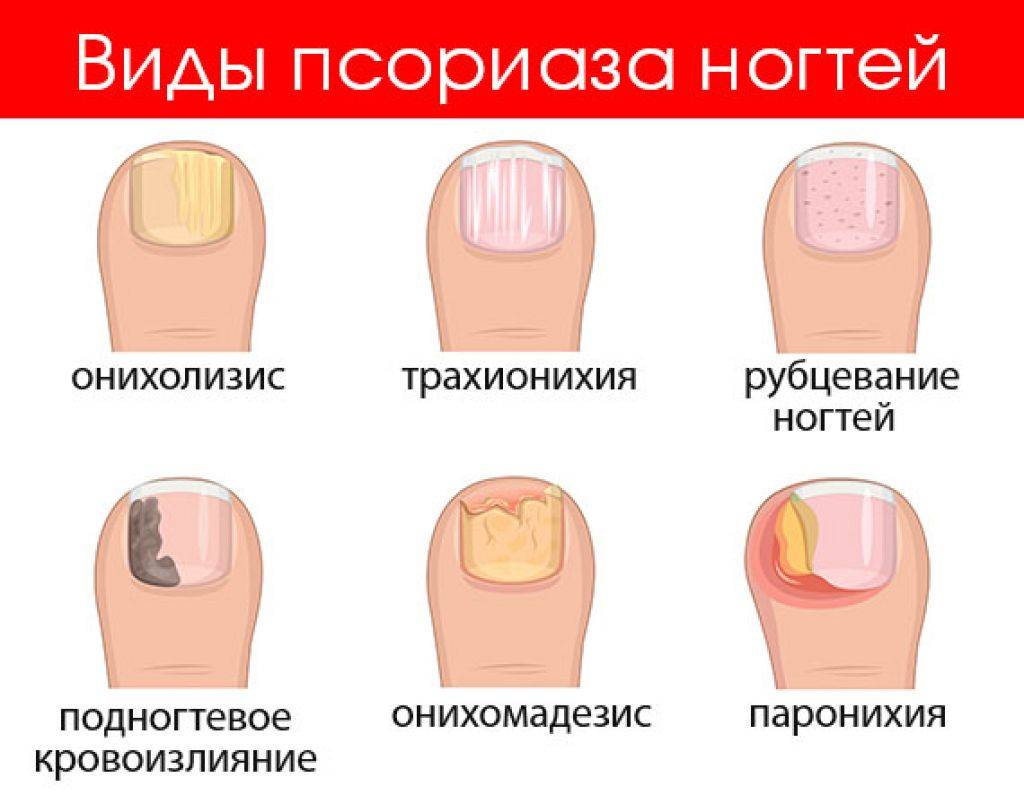 Желтые ногти на руках: причины, лечение