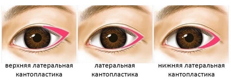 Что такое кантопластика и полная информация о ней