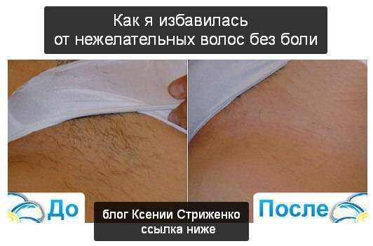 Вросшие волосы после эпиляции: как избавиться от неприятного последствия