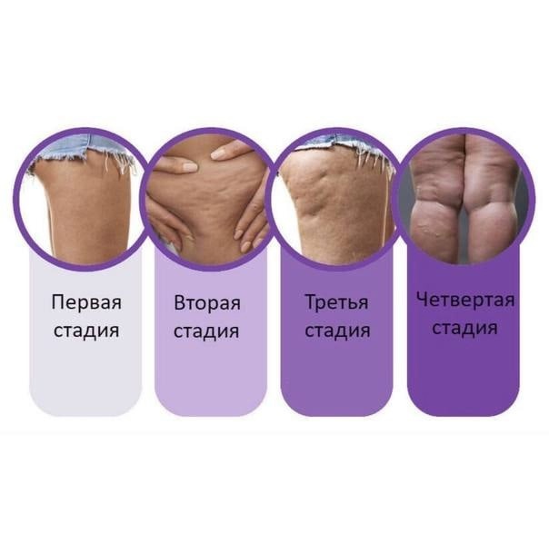Целлюлит — болезнь или норма: стадии и причины целлюлитных отложений * клиника диана в санкт-петербурге