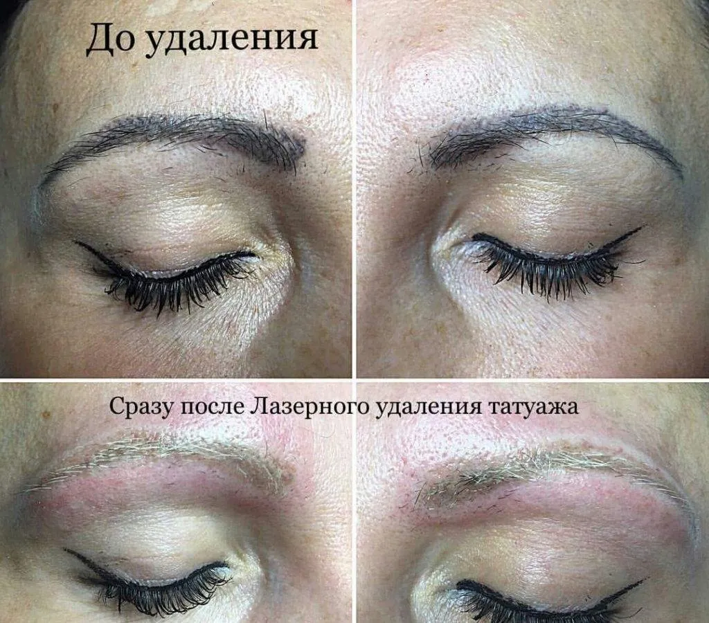 Лазерная коррекция бровей: стоимость услуги в санкт-петербурге | cederman clinic