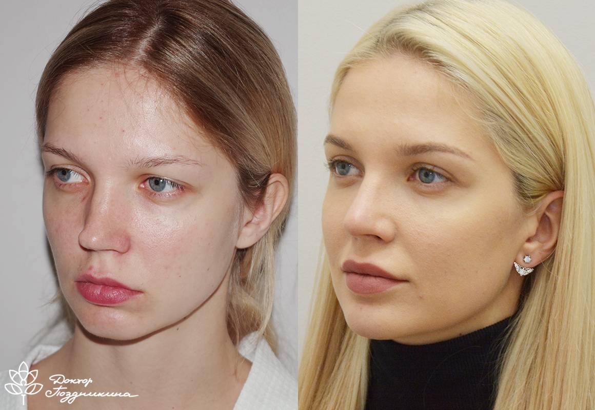 Звезды до и после ринопластики: фото эстонианна, курбан омаров, натали неведрова, лиза боярская, бузова, дениз байсал, матильда шнурова, марина мексика, людмила сенчина и другие