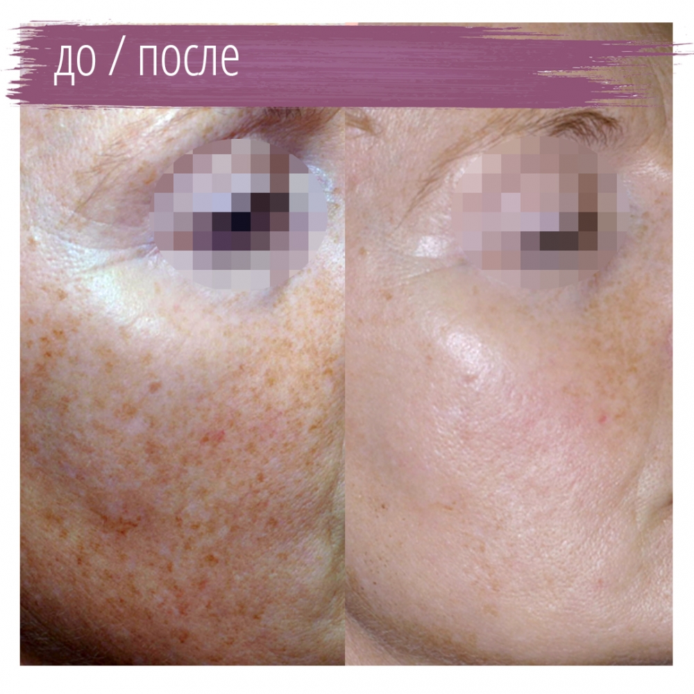 Ipl quantum (квантум) фотоомоложение, фотолечение клиника "отражение"
