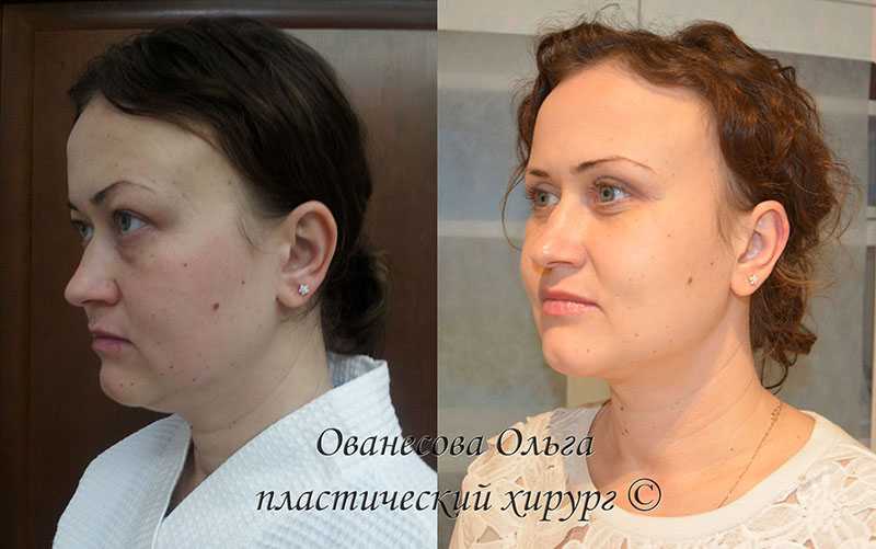 9 советов, как убрать второй подбородок