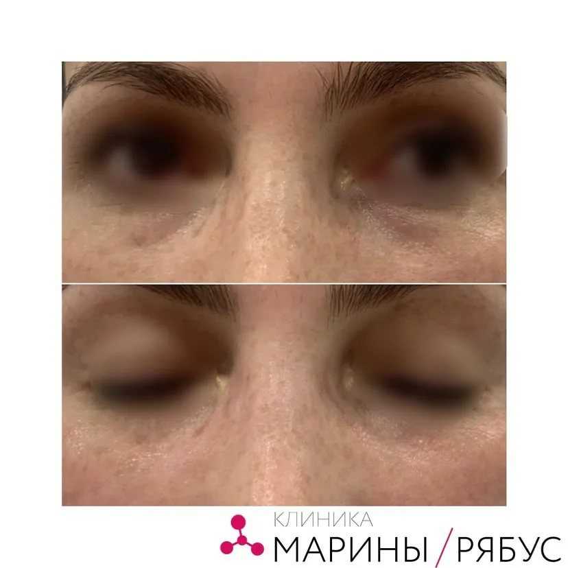 Биоревитализация во время месячных - можно ли делать