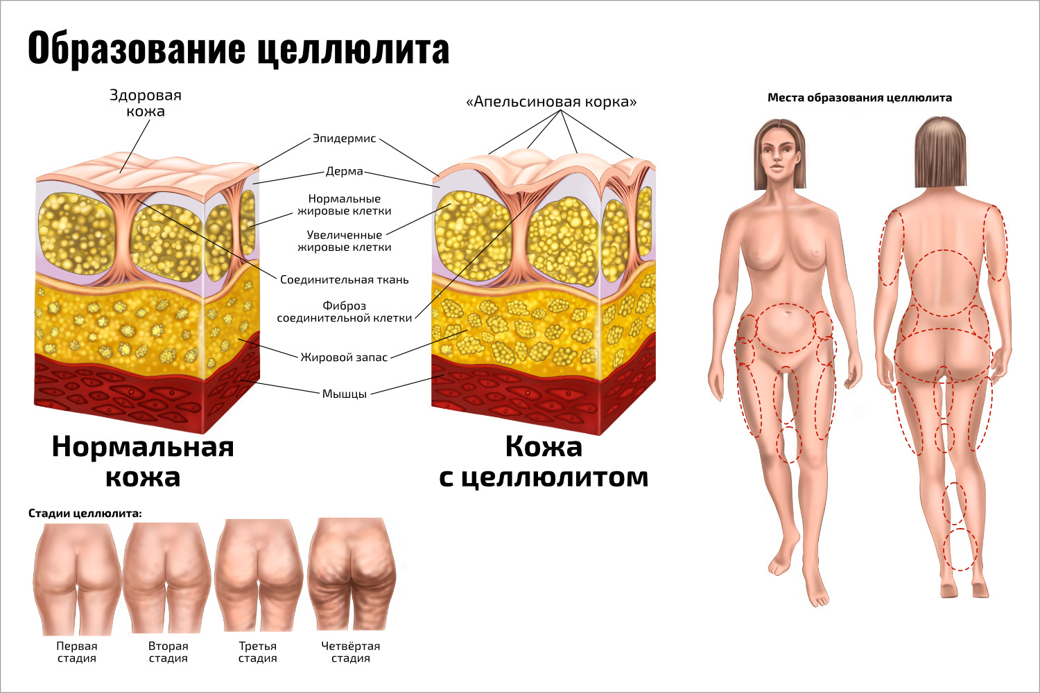 Что такое целлюлит и причины его возникновения даже у худых
что такое целлюлит и причины его возникновения даже у худых
