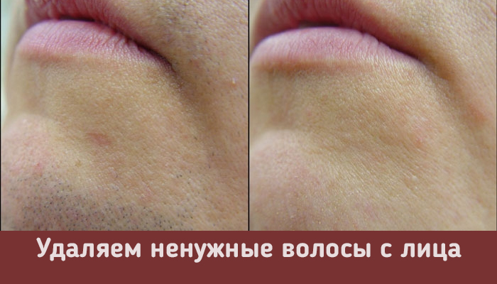 Как избавиться от волос на теле навсегда в домашних условиях
