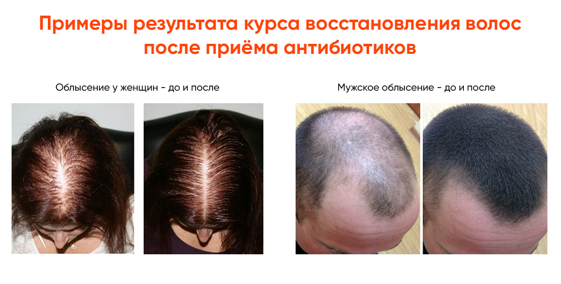 Как остановить выпадение волос: 5 главных советов | volosomanjaki.com