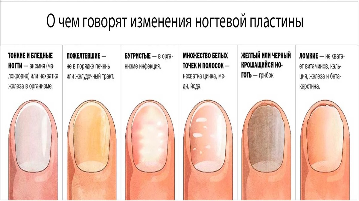 Все о тонких ногтях