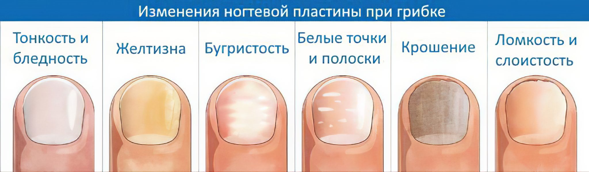 7 простых способов отбелить желтые ногти в домашних условиях