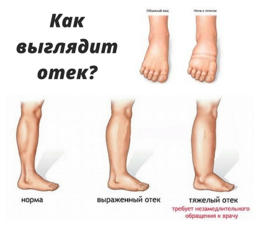 Почему появляются отеки | университетская клиника в спб