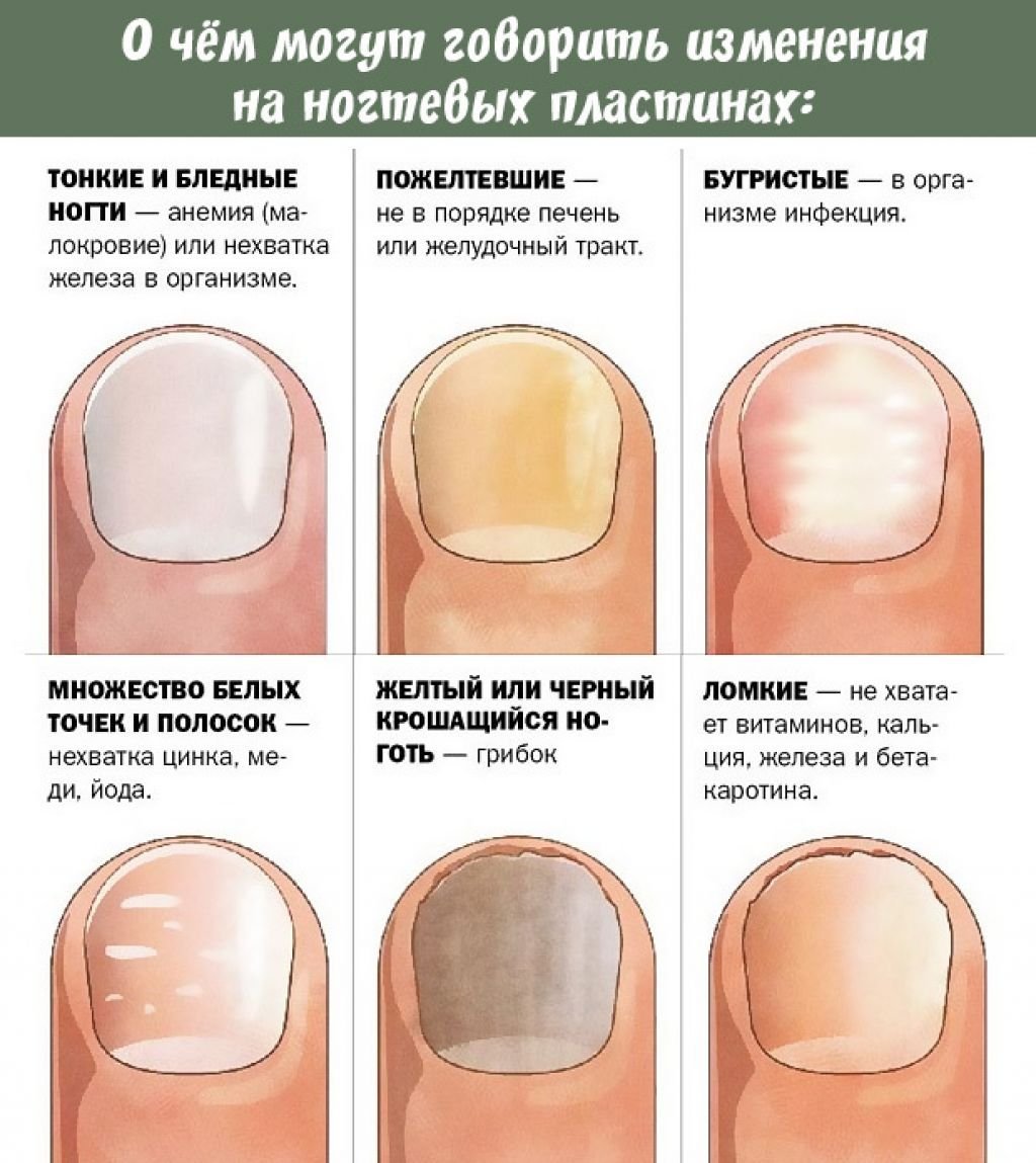 О чем сигнализируют черные полоски на ногтях? лечение и профилактика проблемы